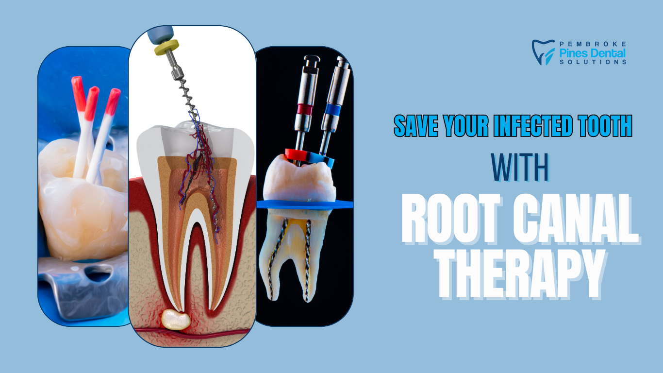 Root Canal in Pembroke Pines, FL