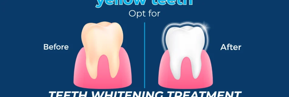 Teeth Whitening Procedures