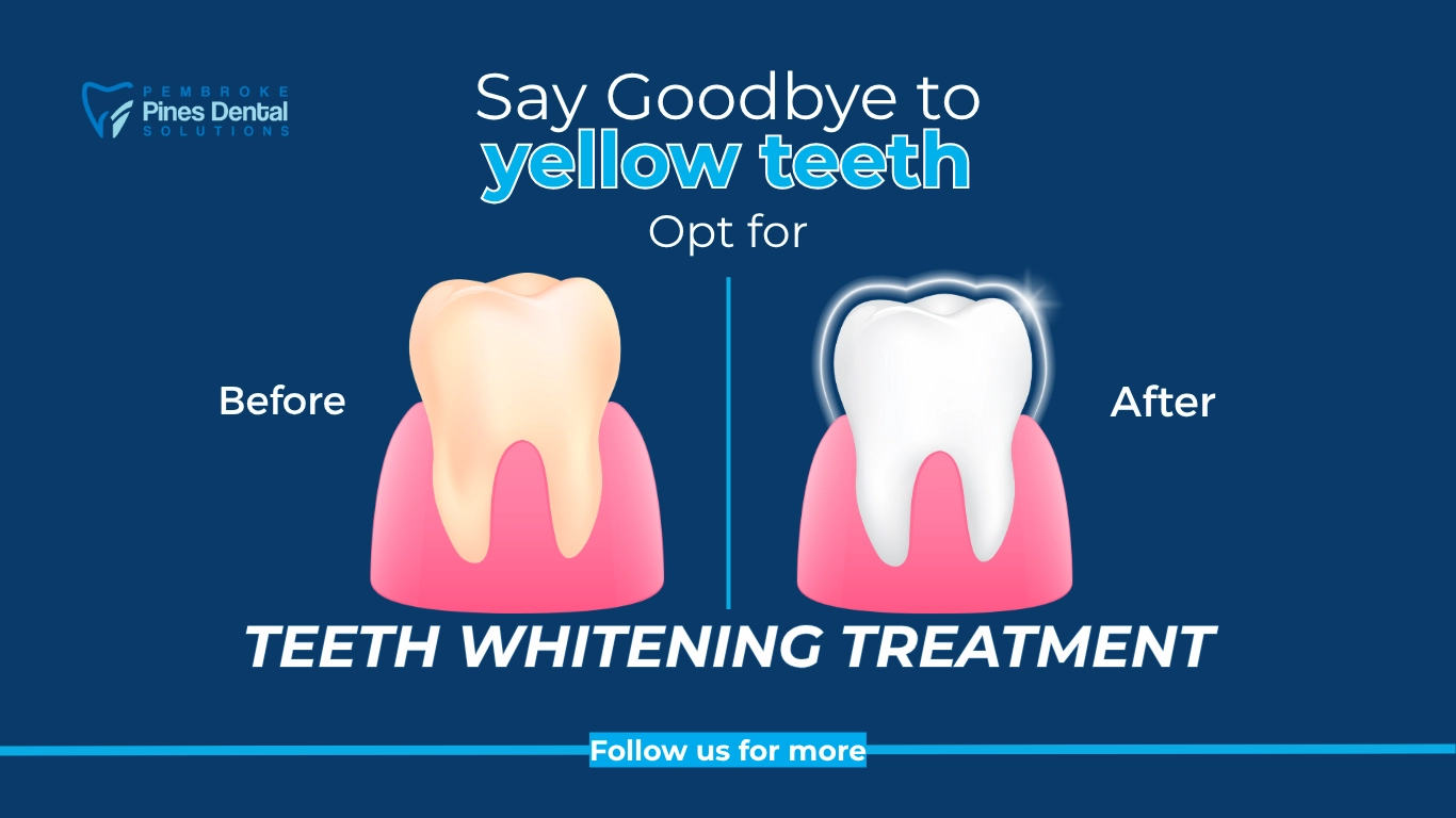 Teeth Whitening Procedures